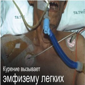 Kazakhstan 2013 Health Effect lung - emphysema